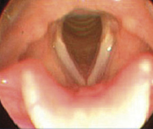 Normal larynx as viewed during FEES